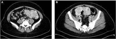 Leiomyomatosis Peritonealis Disseminata Following Laparoscopic Surgery With Uncontained Morcellation: 13 Cases From One Institution